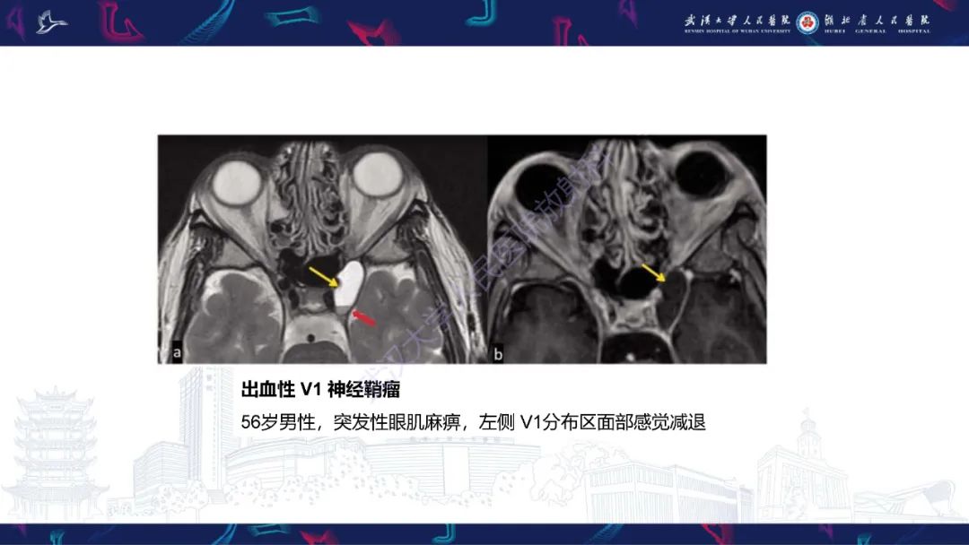 影像PPT - 【PPT】眶尖疾病影像诊断-28