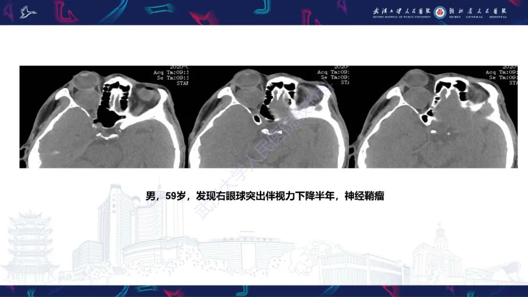 影像PPT - 【PPT】眶尖疾病影像诊断-30