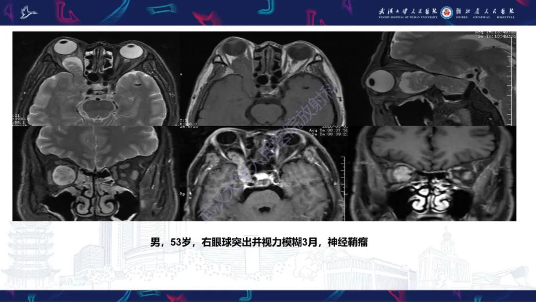 影像PPT - 【PPT】眶尖疾病影像诊断-29