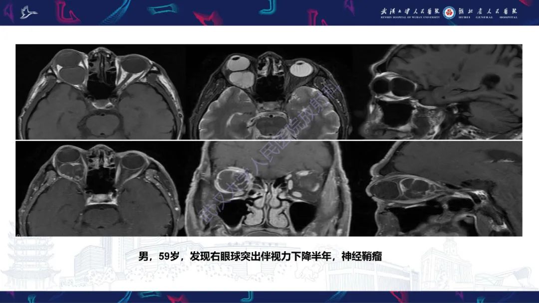 影像PPT - 【PPT】眶尖疾病影像诊断-31