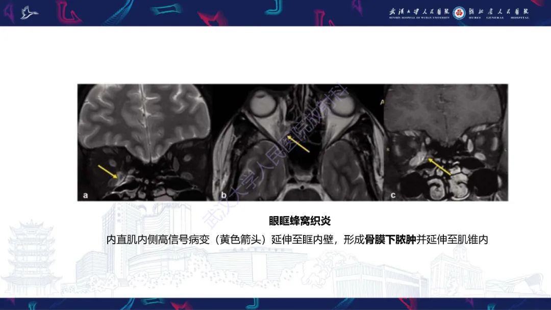影像PPT - 【PPT】眶尖疾病影像诊断-36