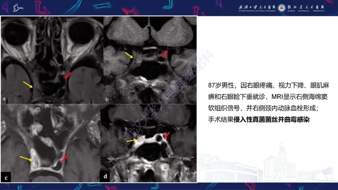 影像PPT - 【PPT】眶尖疾病影像诊断-37