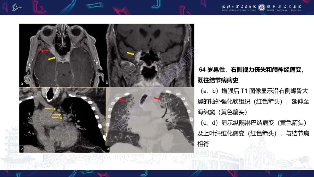 影像PPT - 【PPT】眶尖疾病影像诊断-40