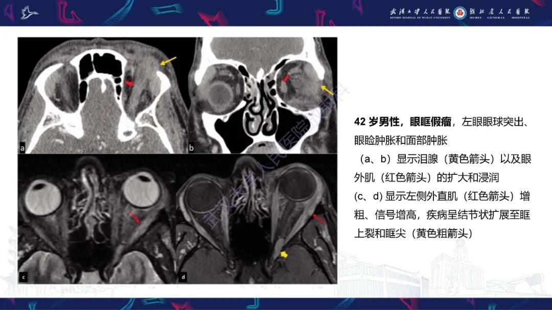 影像PPT - 【PPT】眶尖疾病影像诊断-43
