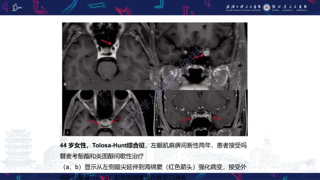 影像PPT - 【PPT】眶尖疾病影像诊断-45