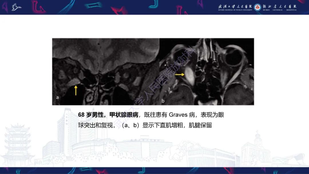 影像PPT - 【PPT】眶尖疾病影像诊断-48