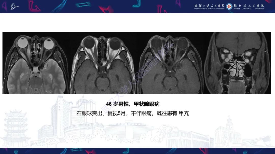 影像PPT - 【PPT】眶尖疾病影像诊断-49