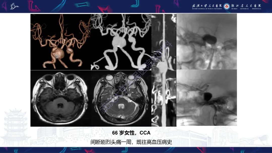 影像PPT - 【PPT】眶尖疾病影像诊断-52