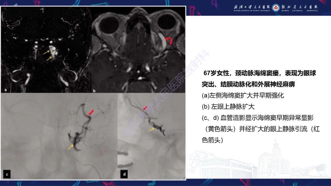 影像PPT - 【PPT】眶尖疾病影像诊断-56