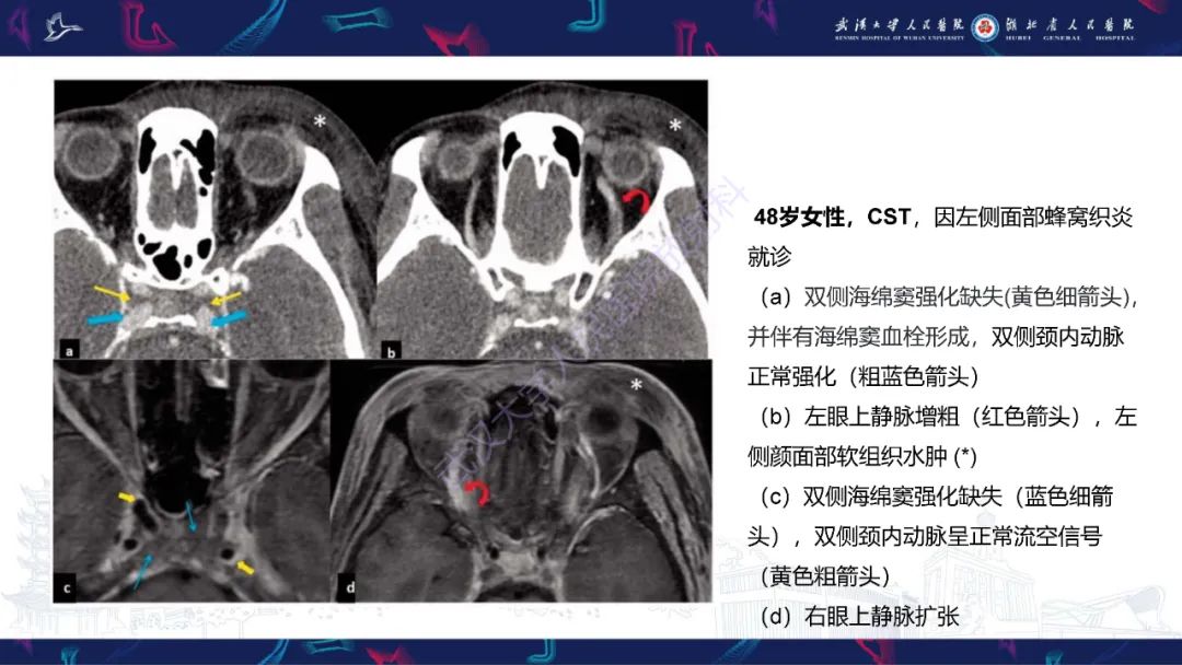 影像PPT - 【PPT】眶尖疾病影像诊断-59
