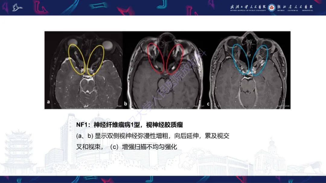 影像PPT - 【PPT】眶尖疾病影像诊断-64