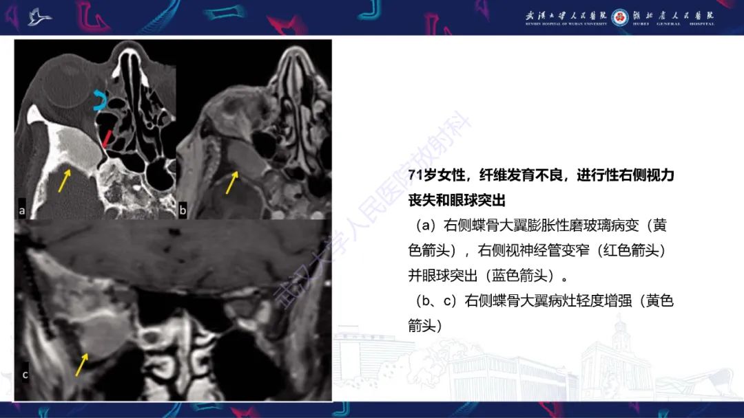 影像PPT - 【PPT】眶尖疾病影像诊断-66