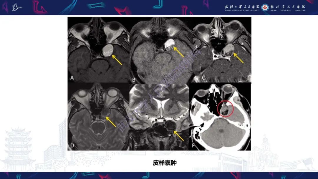 影像PPT - 【PPT】眶尖疾病影像诊断-70