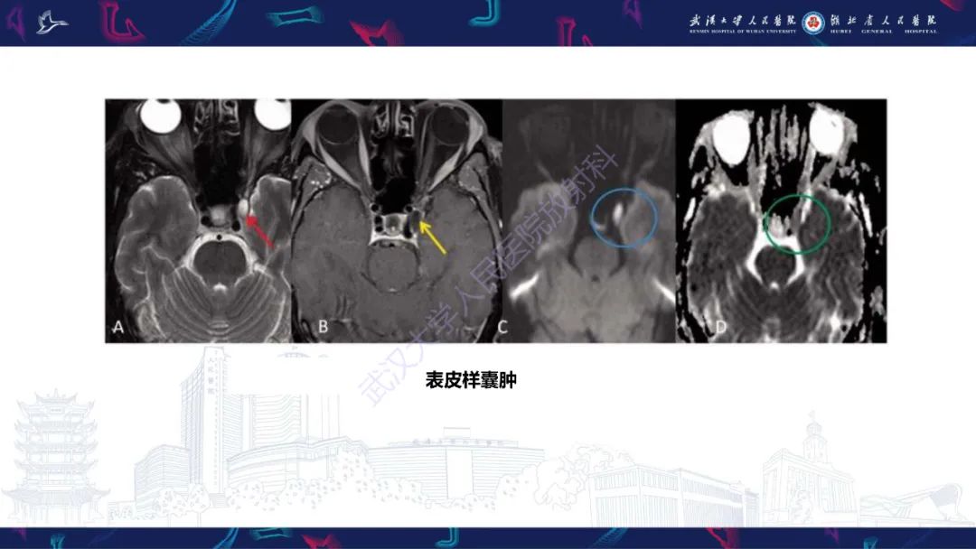 影像PPT - 【PPT】眶尖疾病影像诊断-72