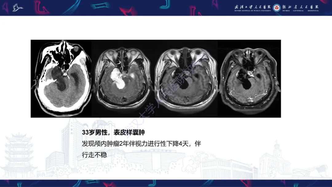 影像PPT - 【PPT】眶尖疾病影像诊断-73