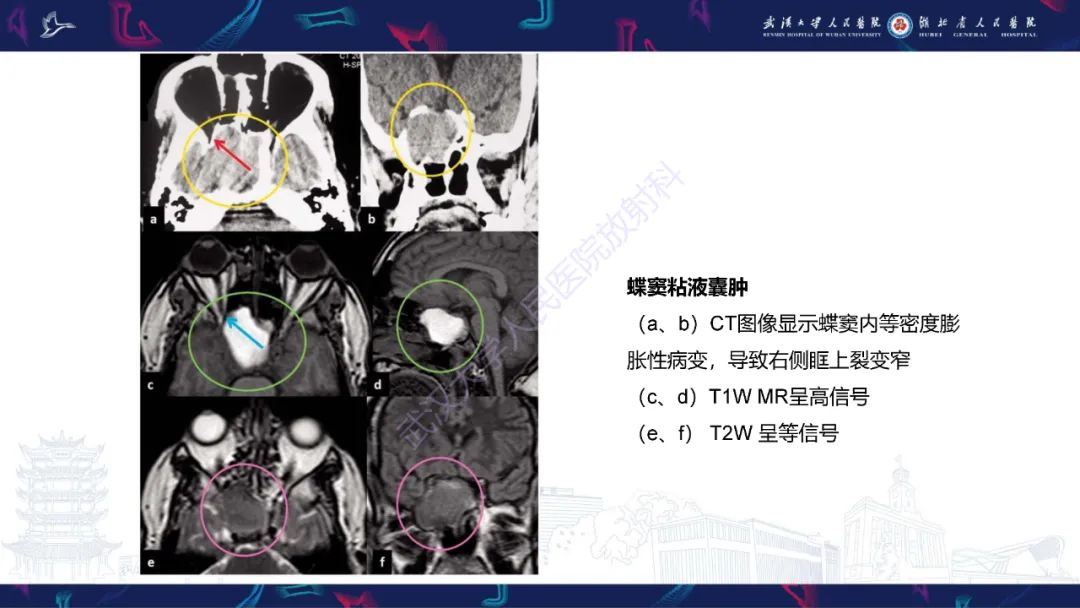 影像PPT - 【PPT】眶尖疾病影像诊断-75