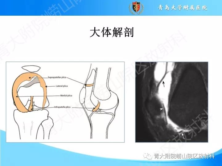 影像PPT - 【PPT】膝关节滑膜皱襞-5