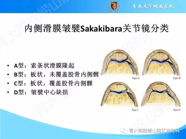 影像PPT - 【PPT】膝关节滑膜皱襞-8