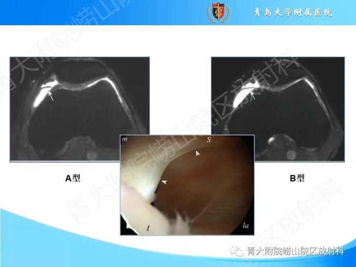 影像PPT - 【PPT】膝关节滑膜皱襞-9