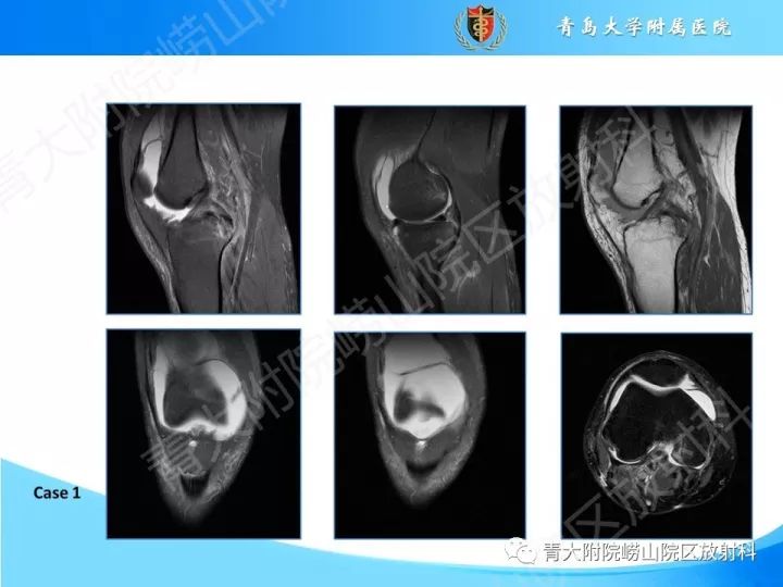 影像PPT - 【PPT】膝关节滑膜皱襞-11