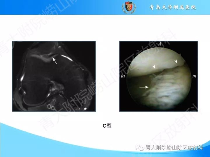 影像PPT - 【PPT】膝关节滑膜皱襞-10