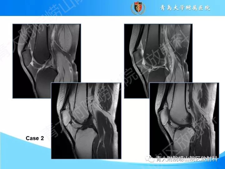 影像PPT - 【PPT】膝关节滑膜皱襞-12