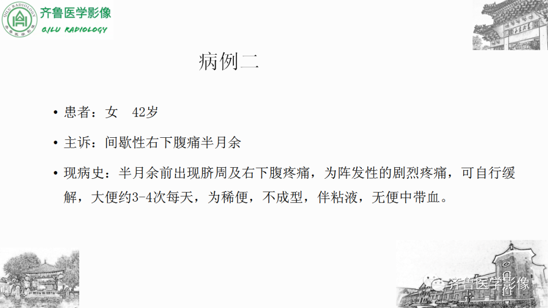 影像PPT - 【PPT】肠套叠-5