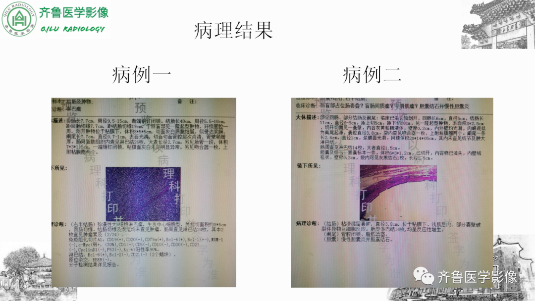 影像PPT - 【PPT】肠套叠-8