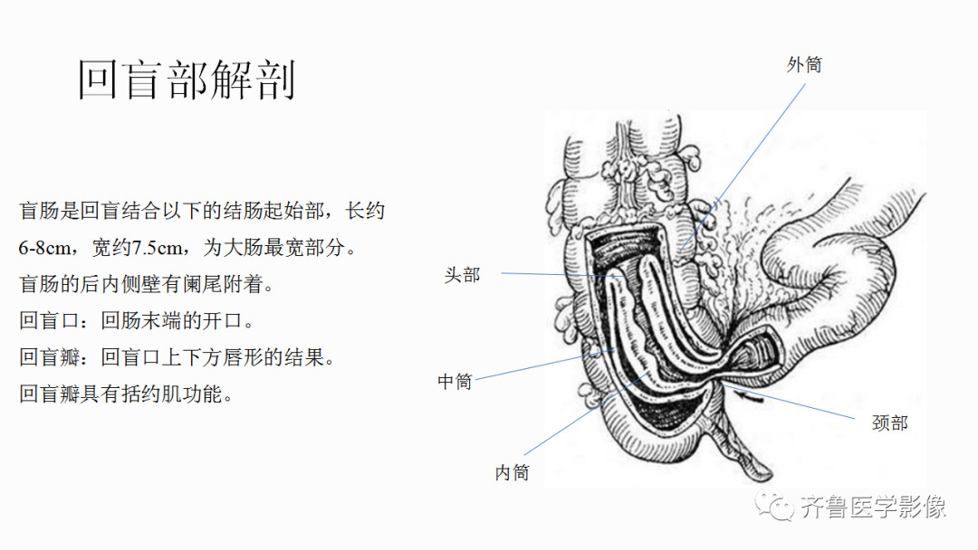 影像PPT - 【PPT】肠套叠-10