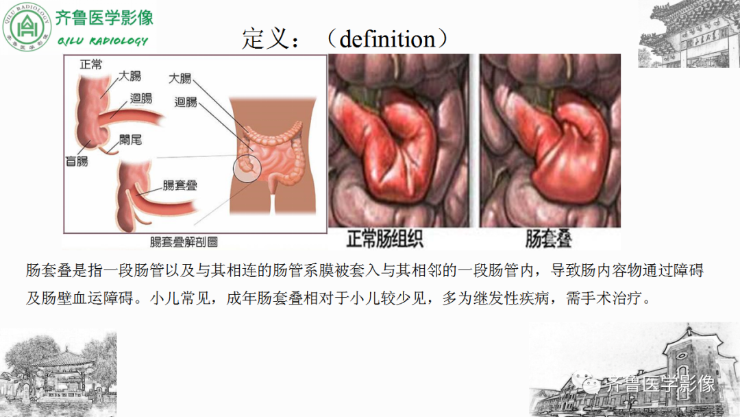 影像PPT - 【PPT】肠套叠-9