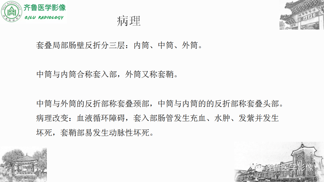 影像PPT - 【PPT】肠套叠-14