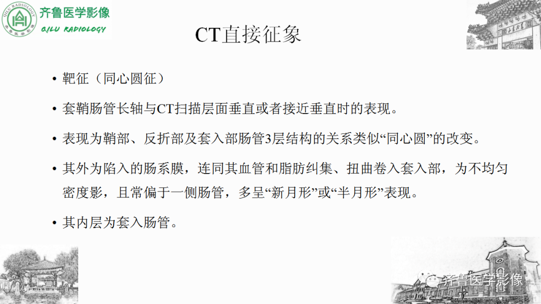 影像PPT - 【PPT】肠套叠-16
