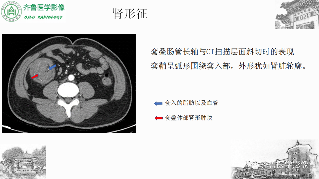 影像PPT - 【PPT】肠套叠-18