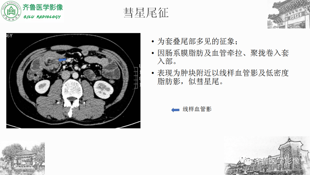影像PPT - 【PPT】肠套叠-19