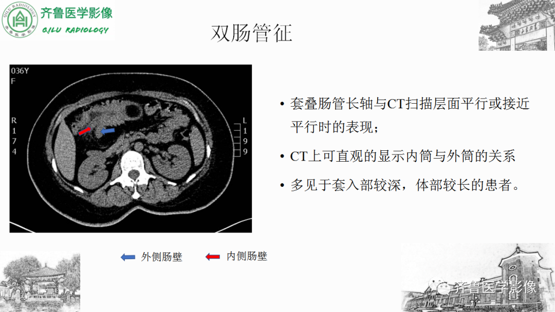 影像PPT - 【PPT】肠套叠-20