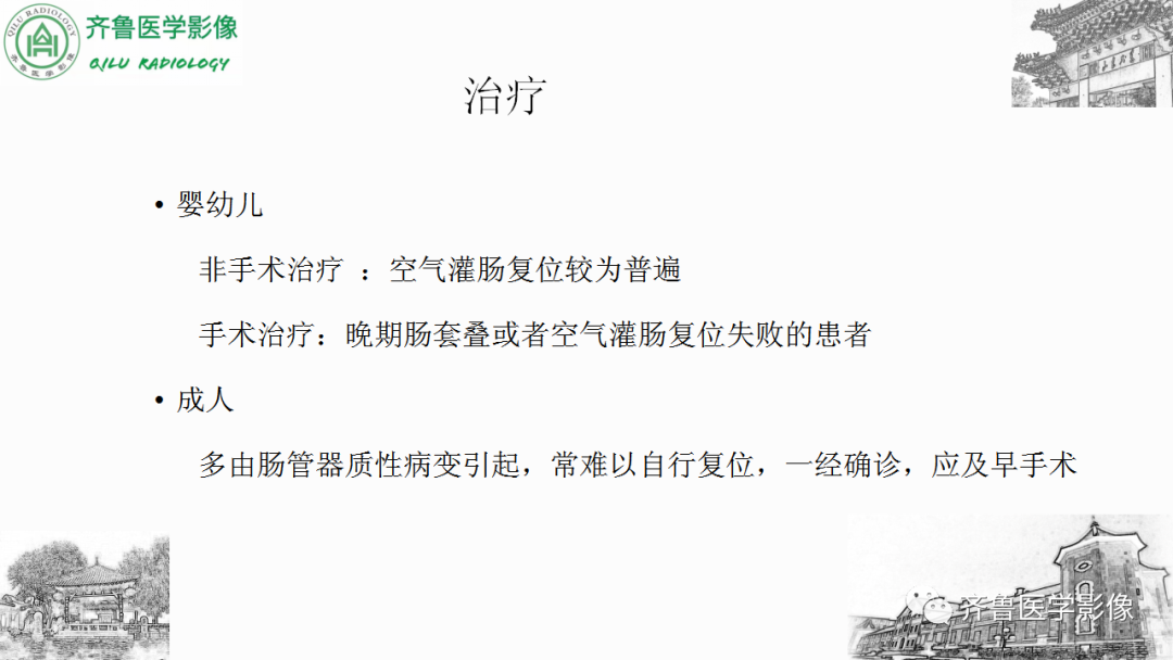 影像PPT - 【PPT】肠套叠-22