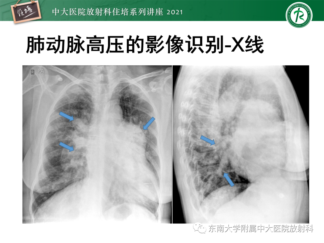 影像PPT - 【PPT】肺动脉高压的影像评估-9