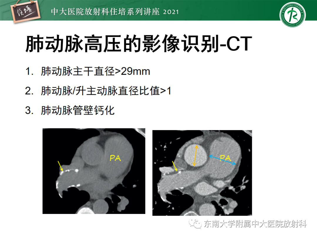 影像PPT - 【PPT】肺动脉高压的影像评估-10