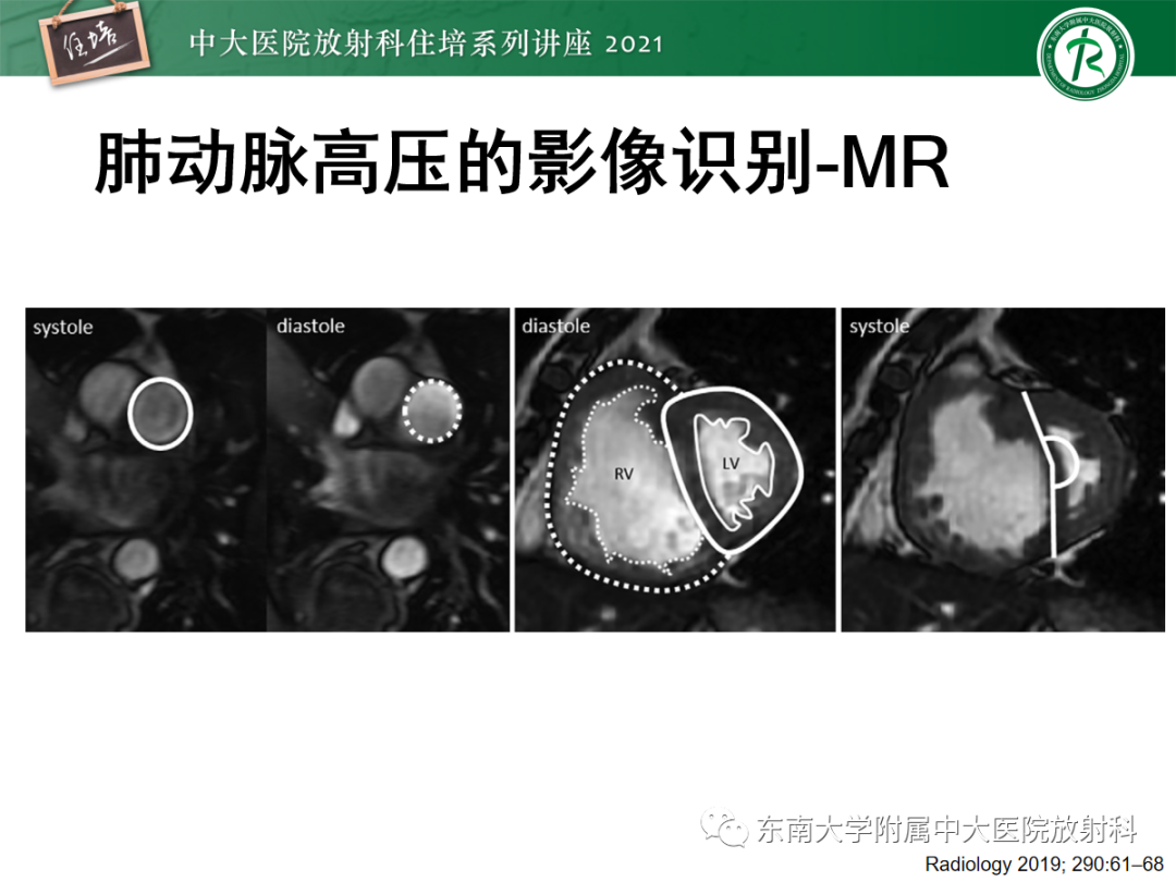 影像PPT - 【PPT】肺动脉高压的影像评估-12