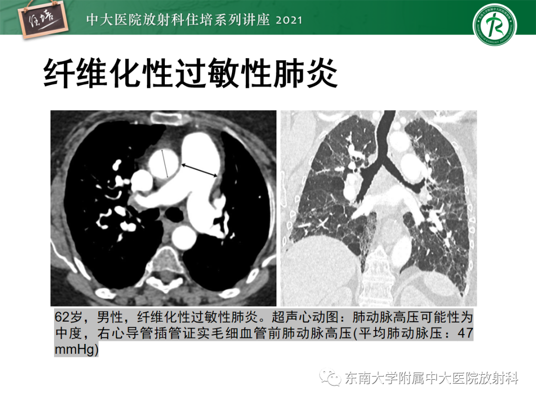 影像PPT - 【PPT】肺动脉高压的影像评估-15