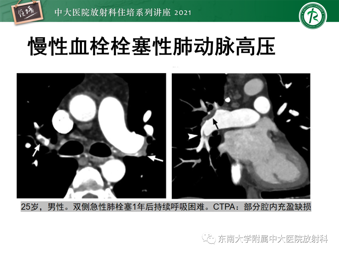 影像PPT - 【PPT】肺动脉高压的影像评估-16