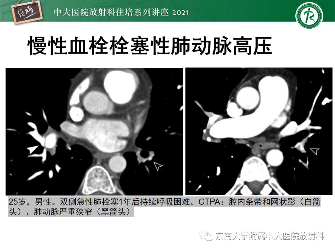 影像PPT - 【PPT】肺动脉高压的影像评估-17