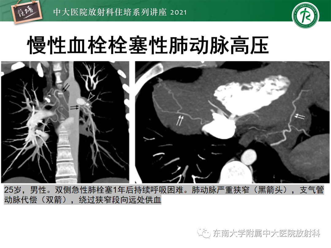 影像PPT - 【PPT】肺动脉高压的影像评估-18