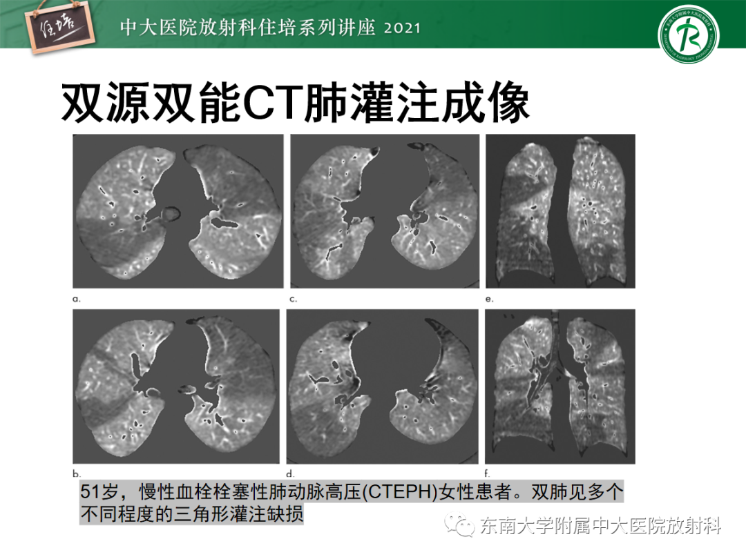 影像PPT - 【PPT】肺动脉高压的影像评估-20