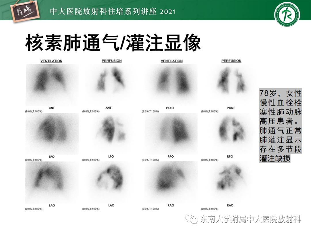 影像PPT - 【PPT】肺动脉高压的影像评估-21