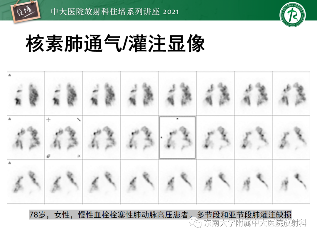 影像PPT - 【PPT】肺动脉高压的影像评估-22