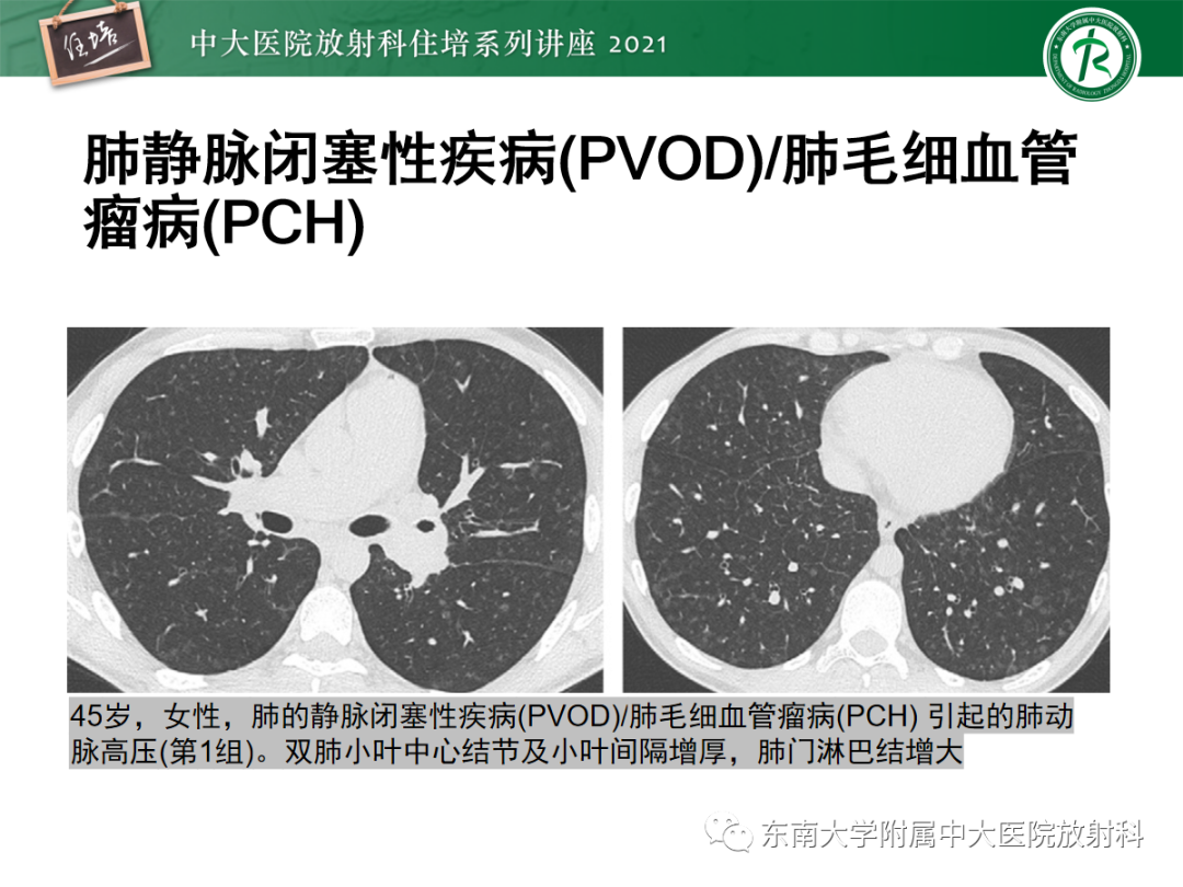 影像PPT - 【PPT】肺动脉高压的影像评估-23