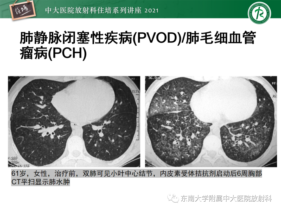 影像PPT - 【PPT】肺动脉高压的影像评估-24
