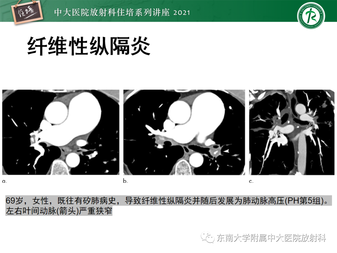 影像PPT - 【PPT】肺动脉高压的影像评估-25