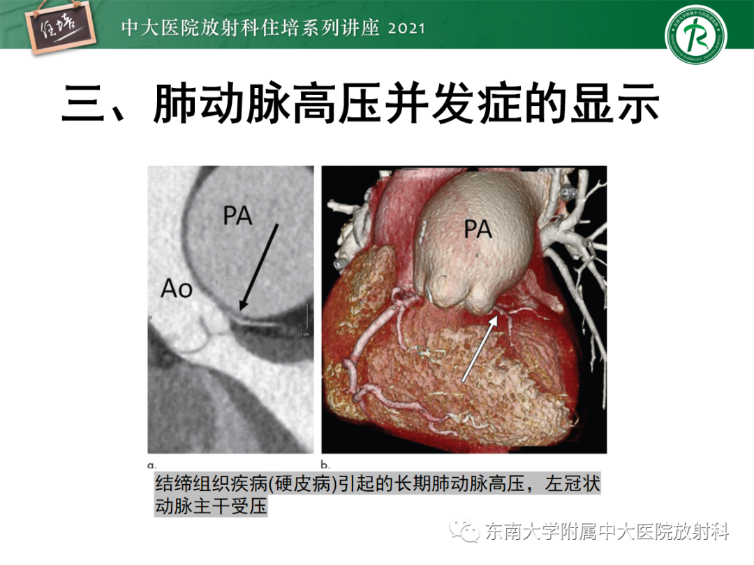 影像PPT - 【PPT】肺动脉高压的影像评估-27